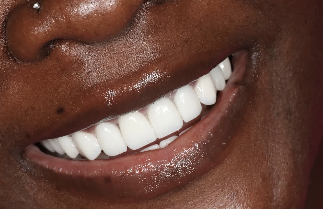 Angled close-up of a smile