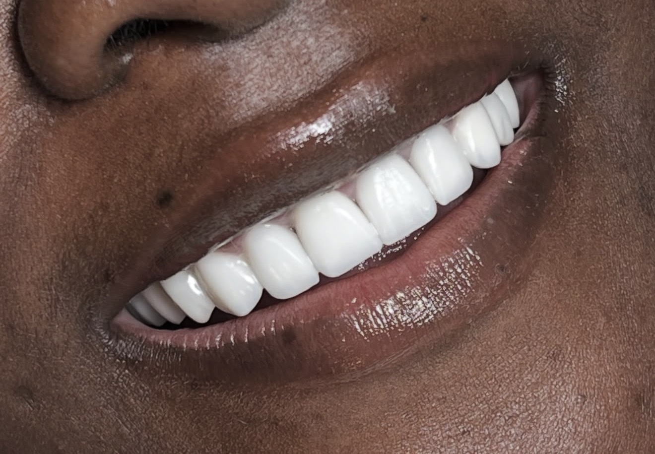 Close-up of upper teeth