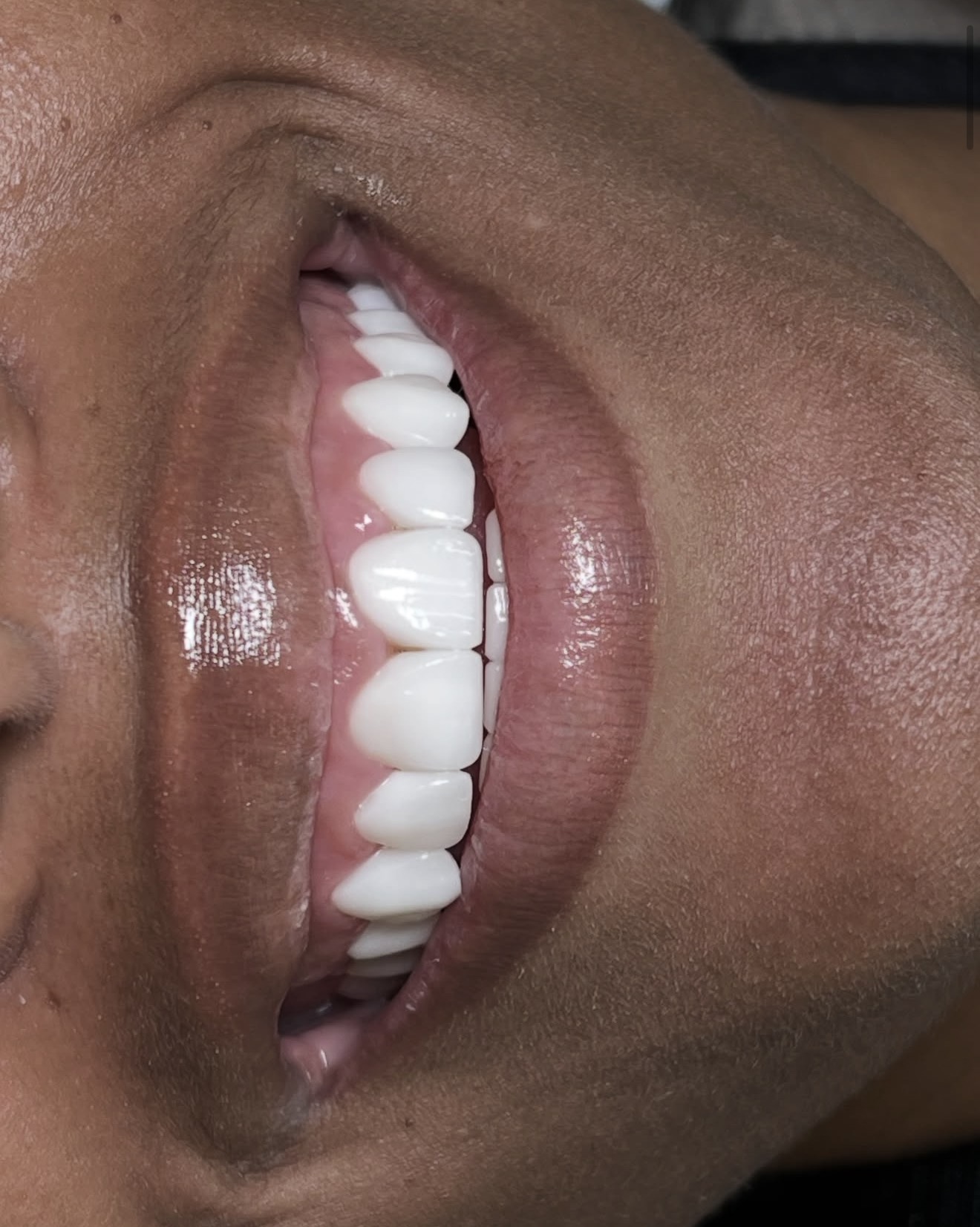 Side view of a smile