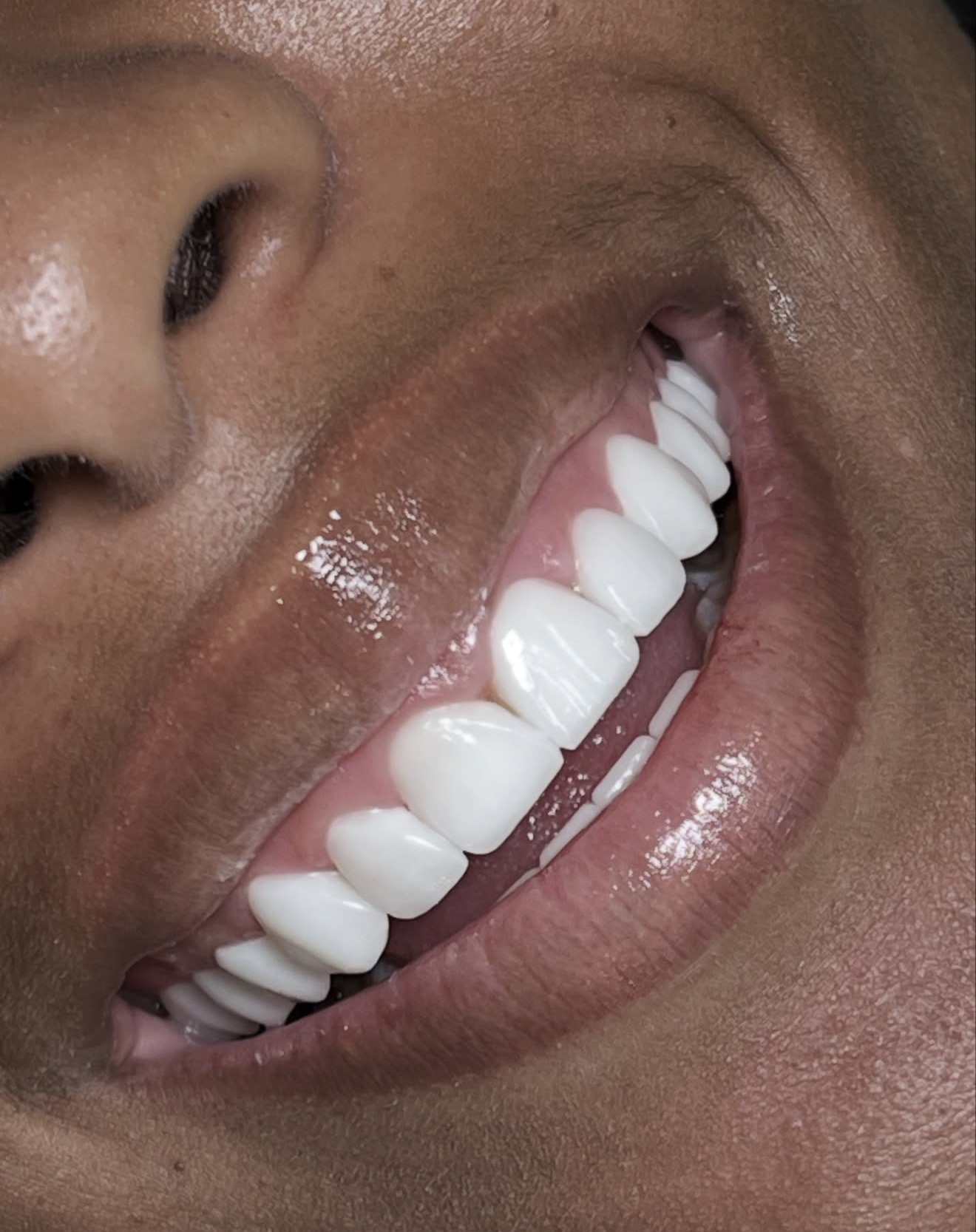 Close-up dental photograph of a smile