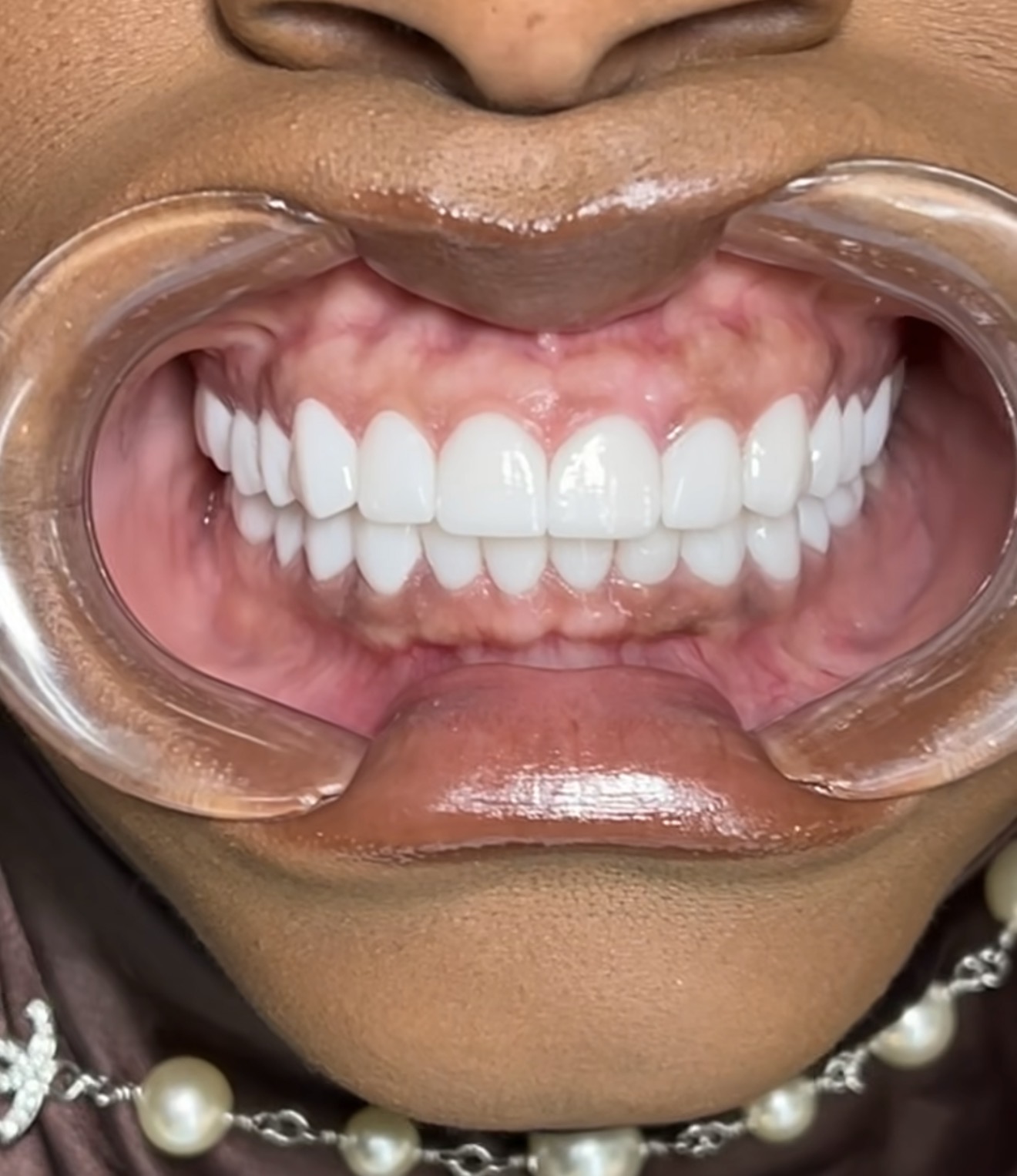 Full view of upper and lower teeth