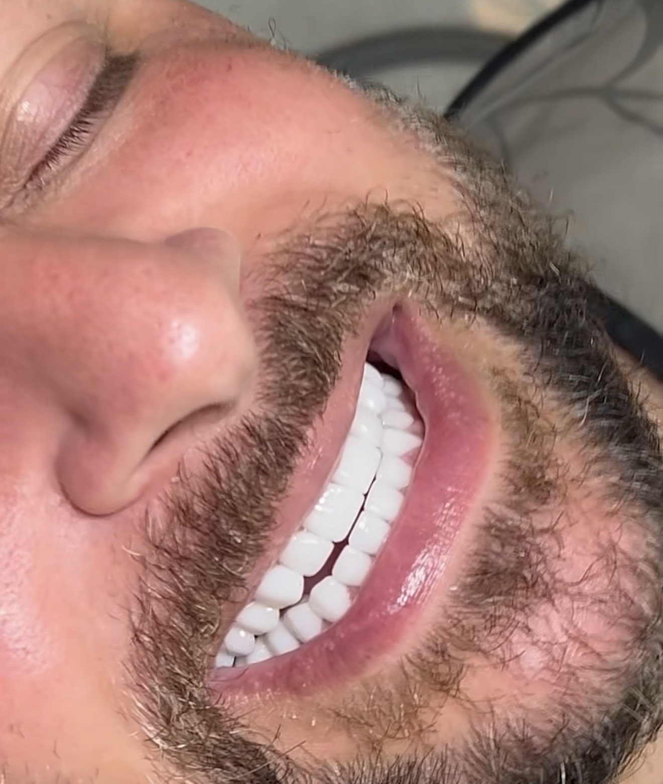 Close-up dental photograph of a smile