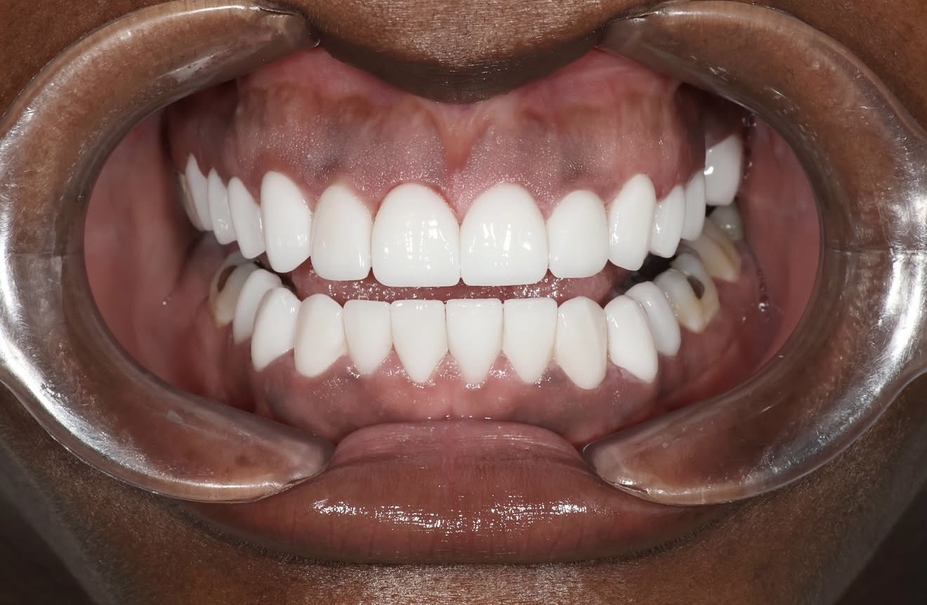 Close-up of upper and lower teeth
